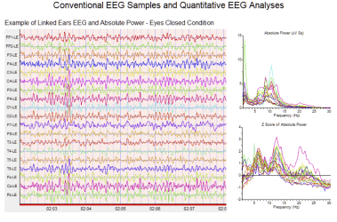 qeeg-detailed-report-page-1.png