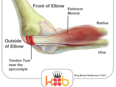 Tennis Elbow and Outer Elbow Pain